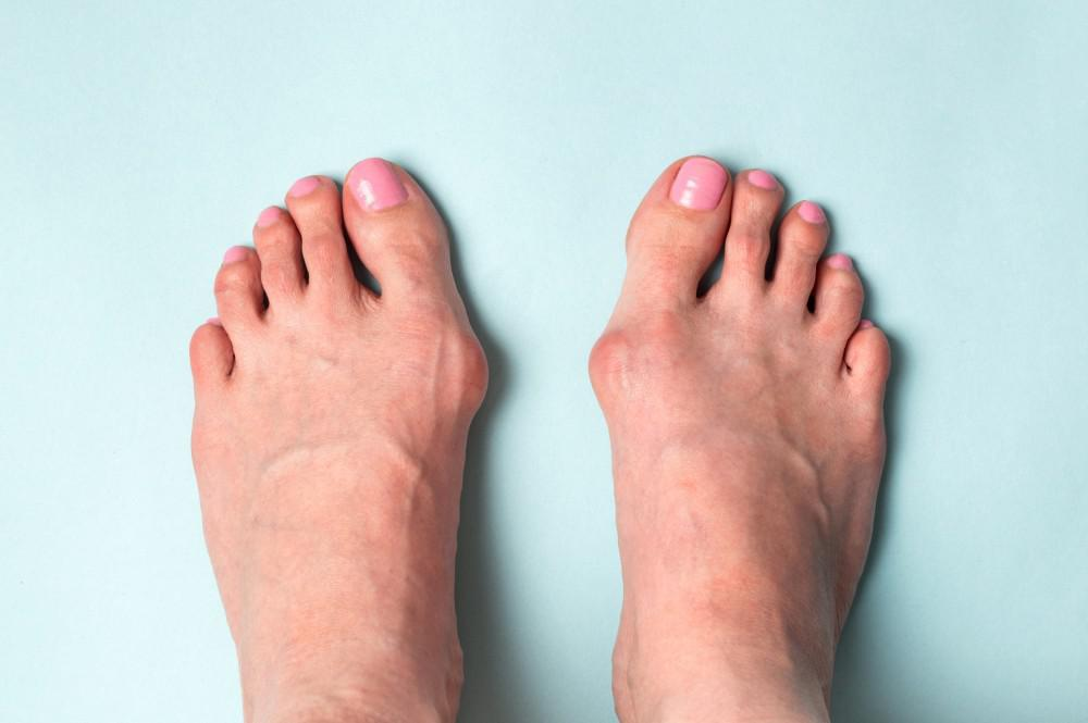 Understanding Bunions, Its Symptoms, Causes, And When To Meet A Podiatrist