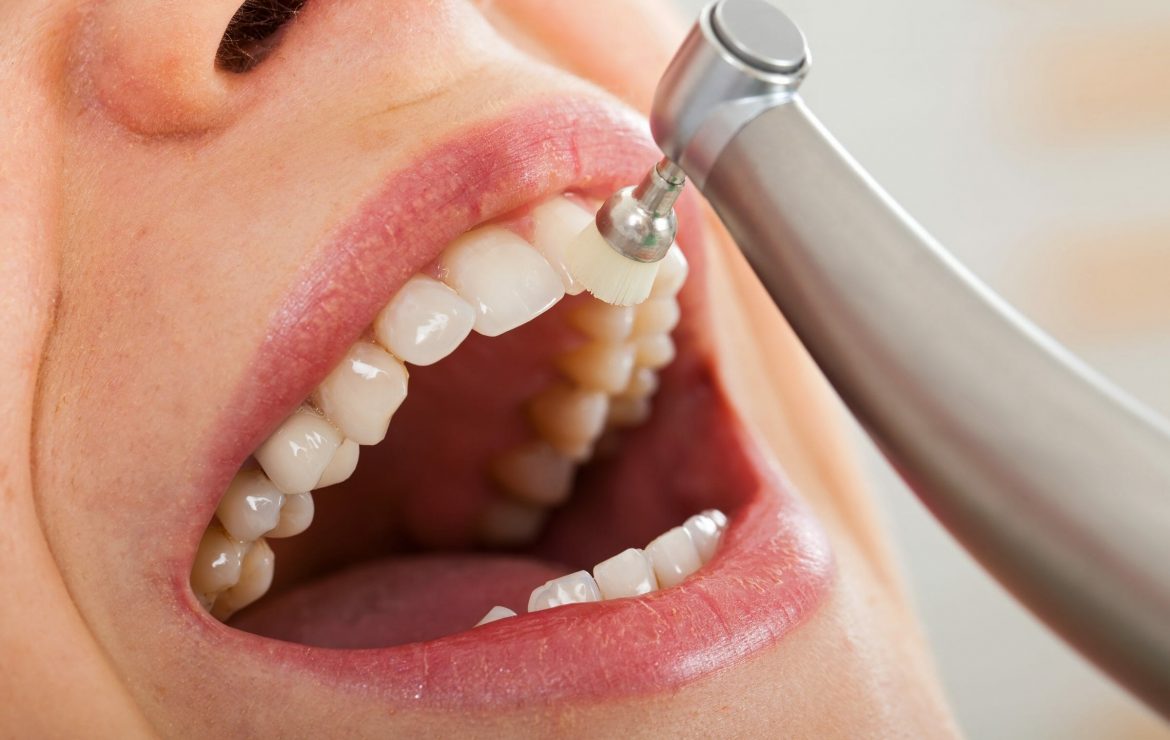How Often Should You Have a Dental Cleaning? 